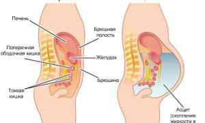 Асцит при циррозе печени
