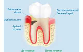 Почему болят десна и как их лечить