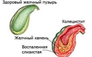 Как вылечить холецистит
