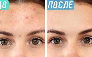 Как можно избавиться от прыщей на лбу?