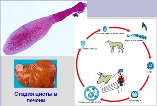 Альвеококкоз
