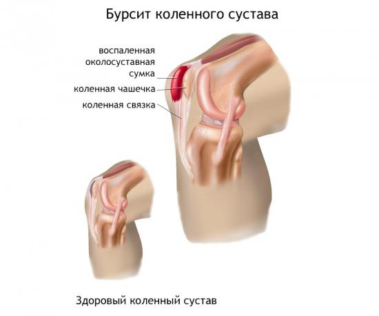 Бурсит