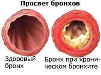 чем лечить хронический бронхит