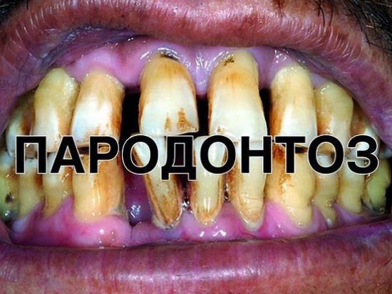 Запущенный пародонтоз