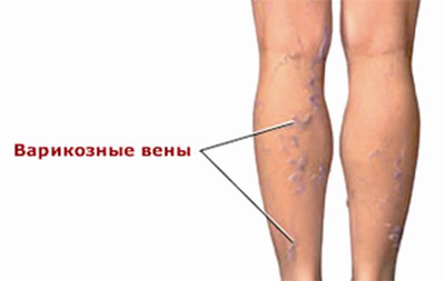 варикозное расширение вен